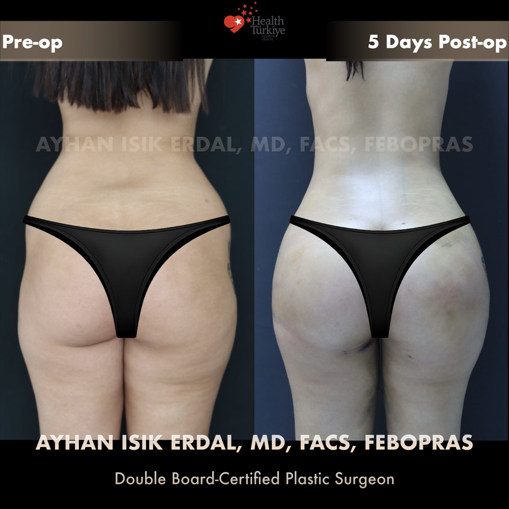 Hip dip correction with waist contouring — Back view — lateral hollows filled, gluteal shape respected, patient of Dr. Ayhan Işık Erdal, Istanbul