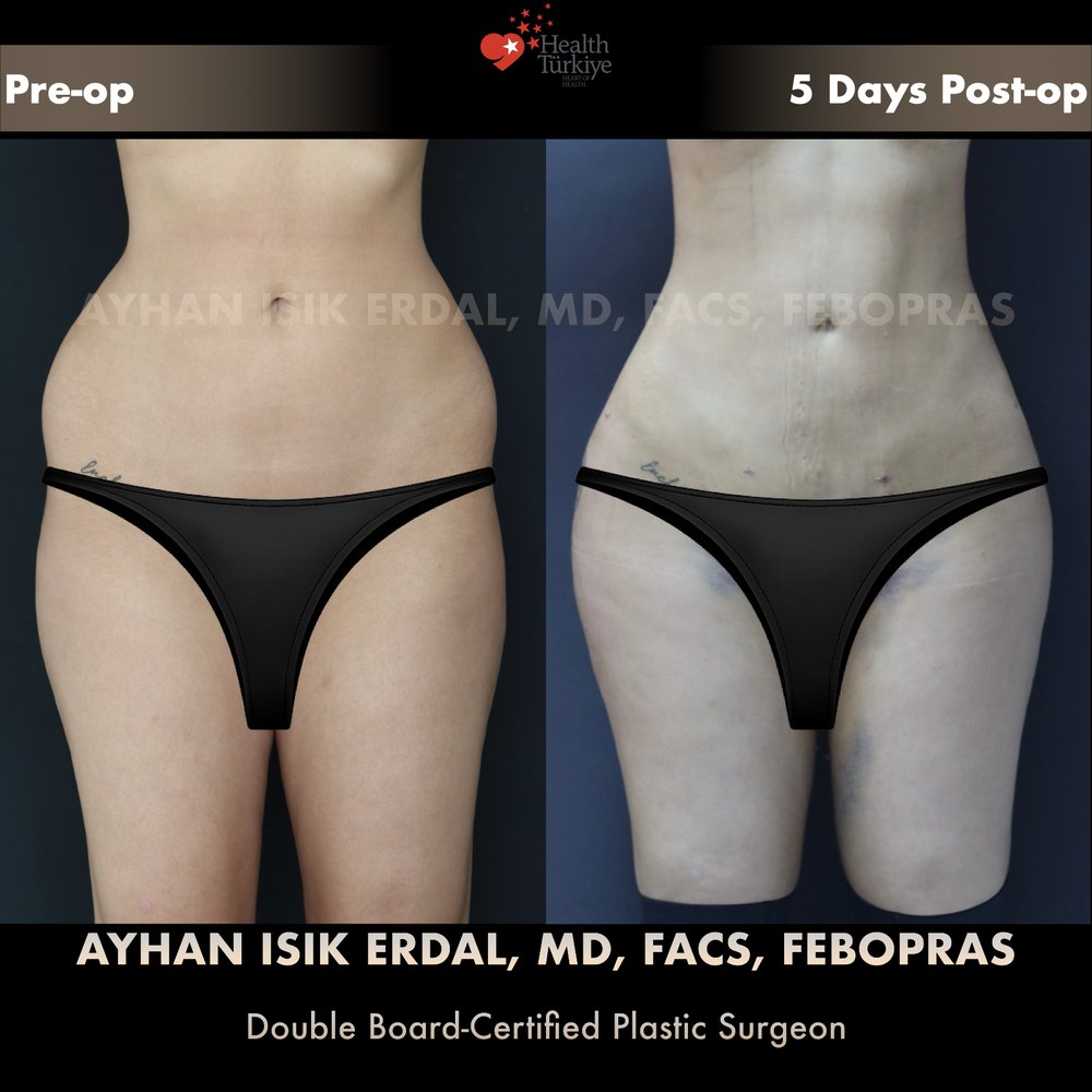 Hip dip correction with waist contouring — Front view — the waist-to-thigh line already flowing at day 5, patient of Dr. Ayhan Işık Erdal, Istanbul
