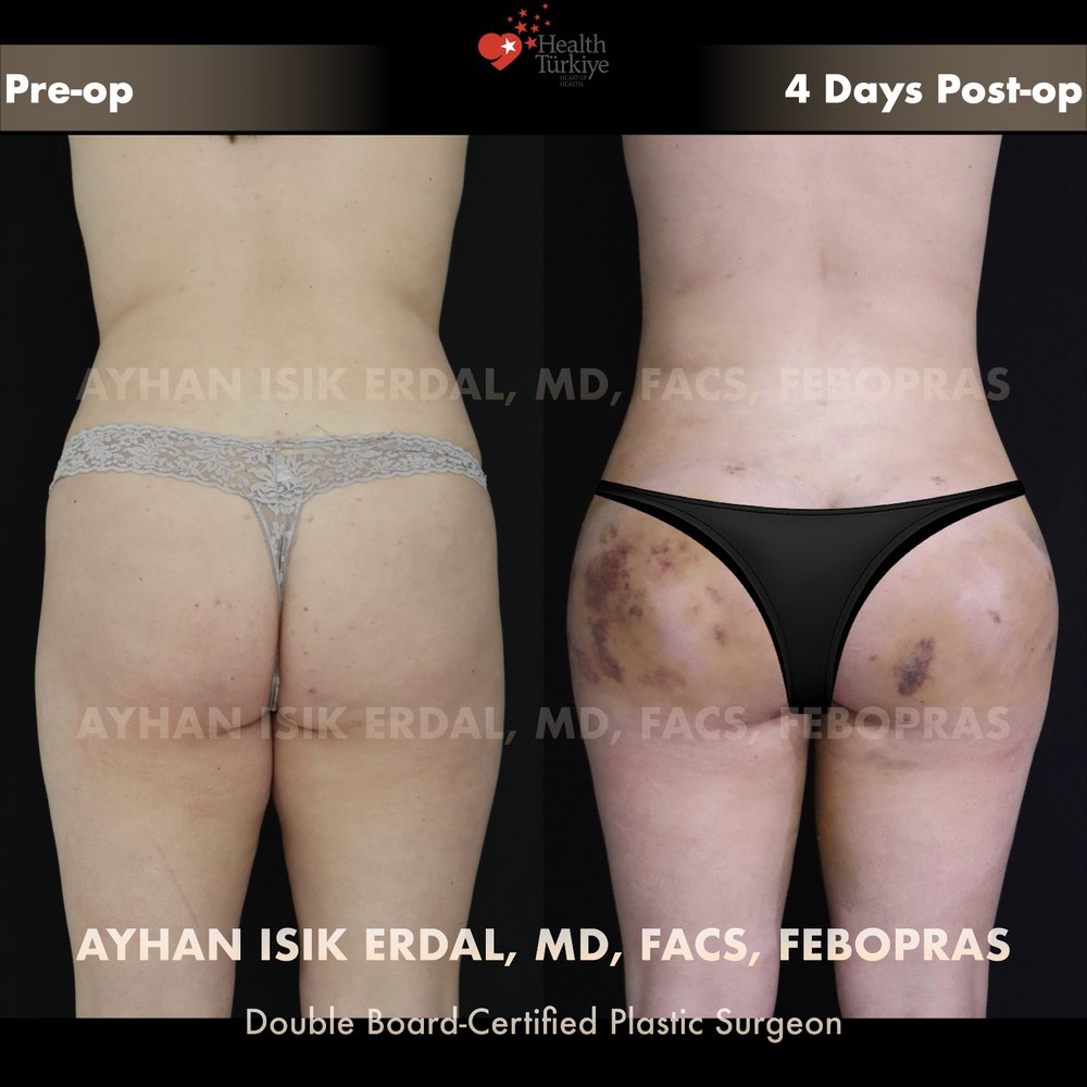 Waist liposuction + hip dip fat transfer — Back view, day 4 — bruising at donor and graft zones is normal early biology, patient of Dr. Ayhan Işık Erdal, Istanbul