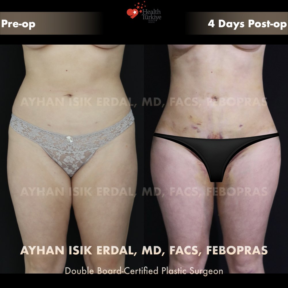 Waist liposuction + hip dip fat transfer — Front view, day 4, patient of Dr. Ayhan Işık Erdal, Istanbul