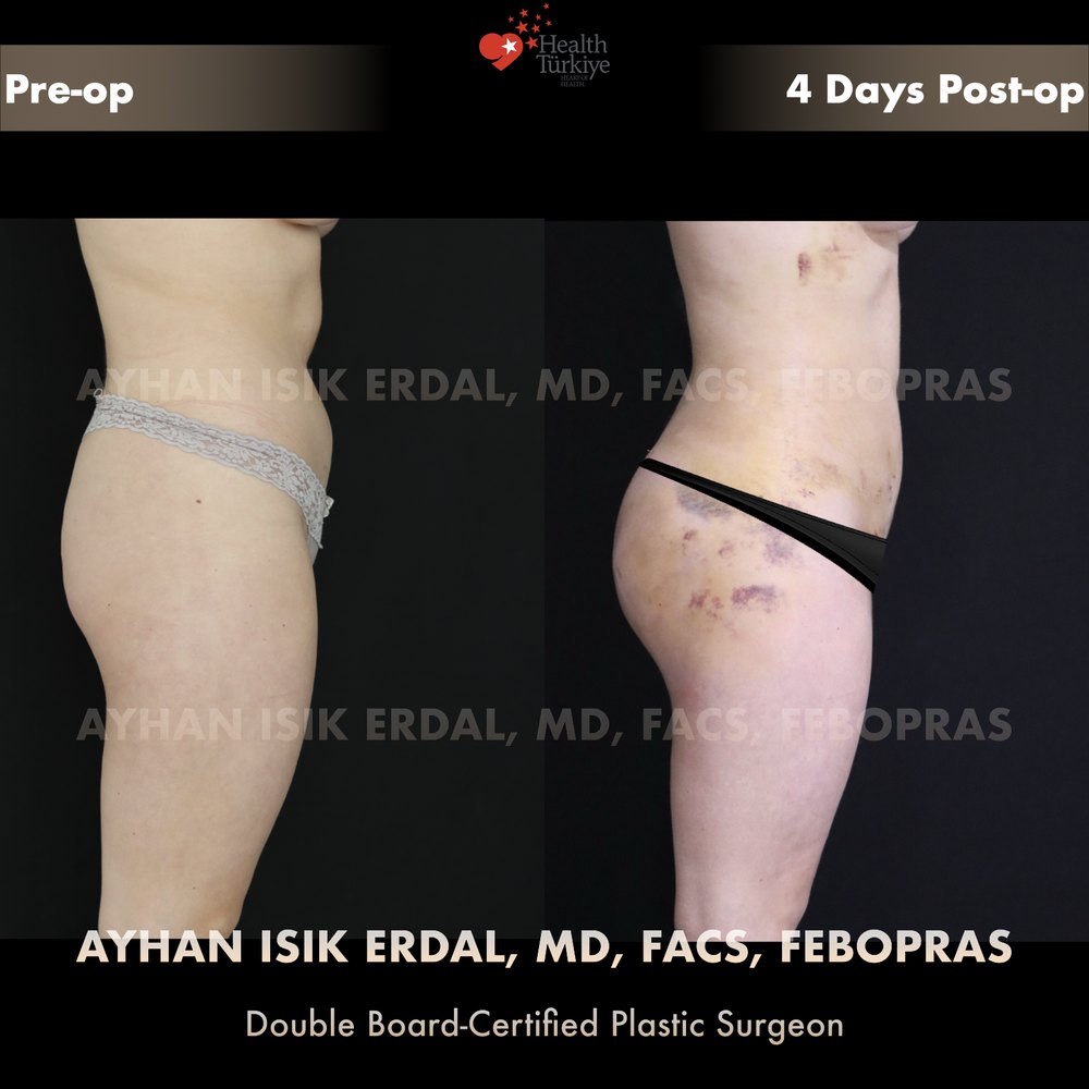 Waist liposuction + hip dip fat transfer — Side view, day 4 — the lateral line smoothing, patient of Dr. Ayhan Işık Erdal, Istanbul