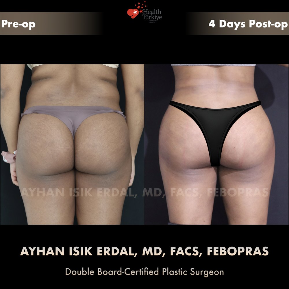 Hip dip correction with gluteal blending — Back view, day 4, patient of Dr. Ayhan Işık Erdal, Istanbul