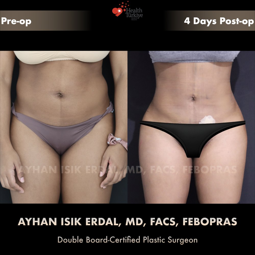Hip dip correction with gluteal blending — Front view, day 4, patient of Dr. Ayhan Işık Erdal, Istanbul