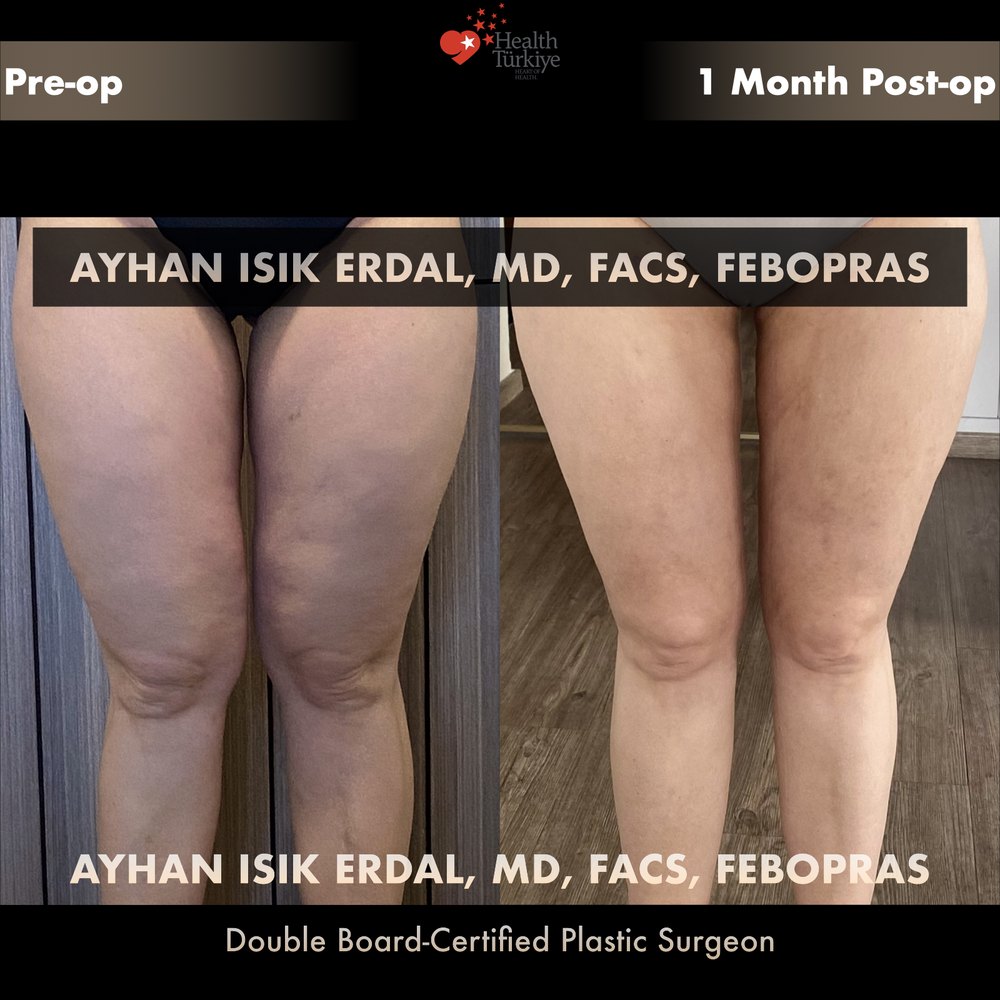 One month post-op — the contour mid-settling — Front thigh/hip line at 1 month — settling honestly documented, patient of Dr. Ayhan Işık Erdal, Istanbul
