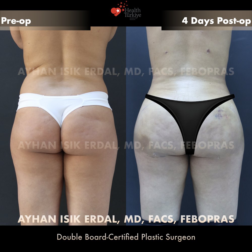 Waist contouring + hip & gluteal fat transfer — Back view, day 4, patient of Dr. Ayhan Işık Erdal, Istanbul