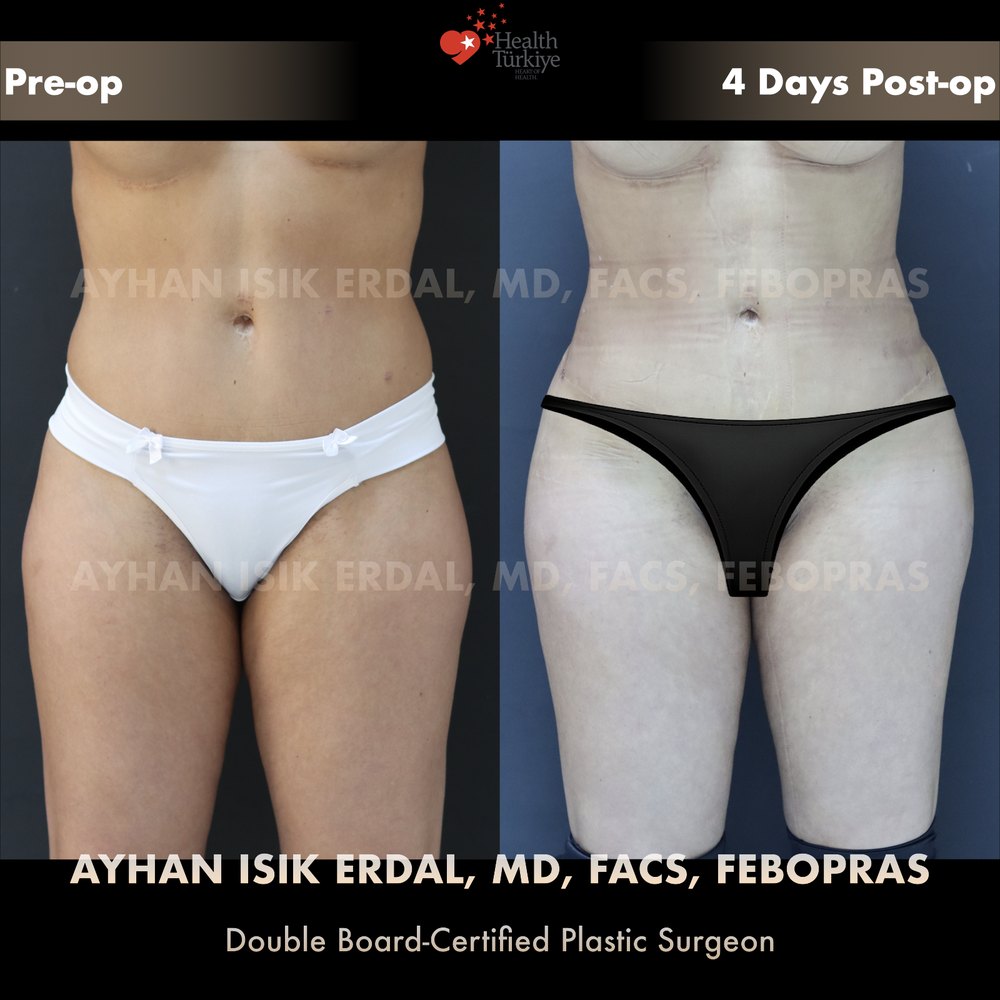 Waist contouring + hip & gluteal fat transfer — Front view, day 4, patient of Dr. Ayhan Işık Erdal, Istanbul