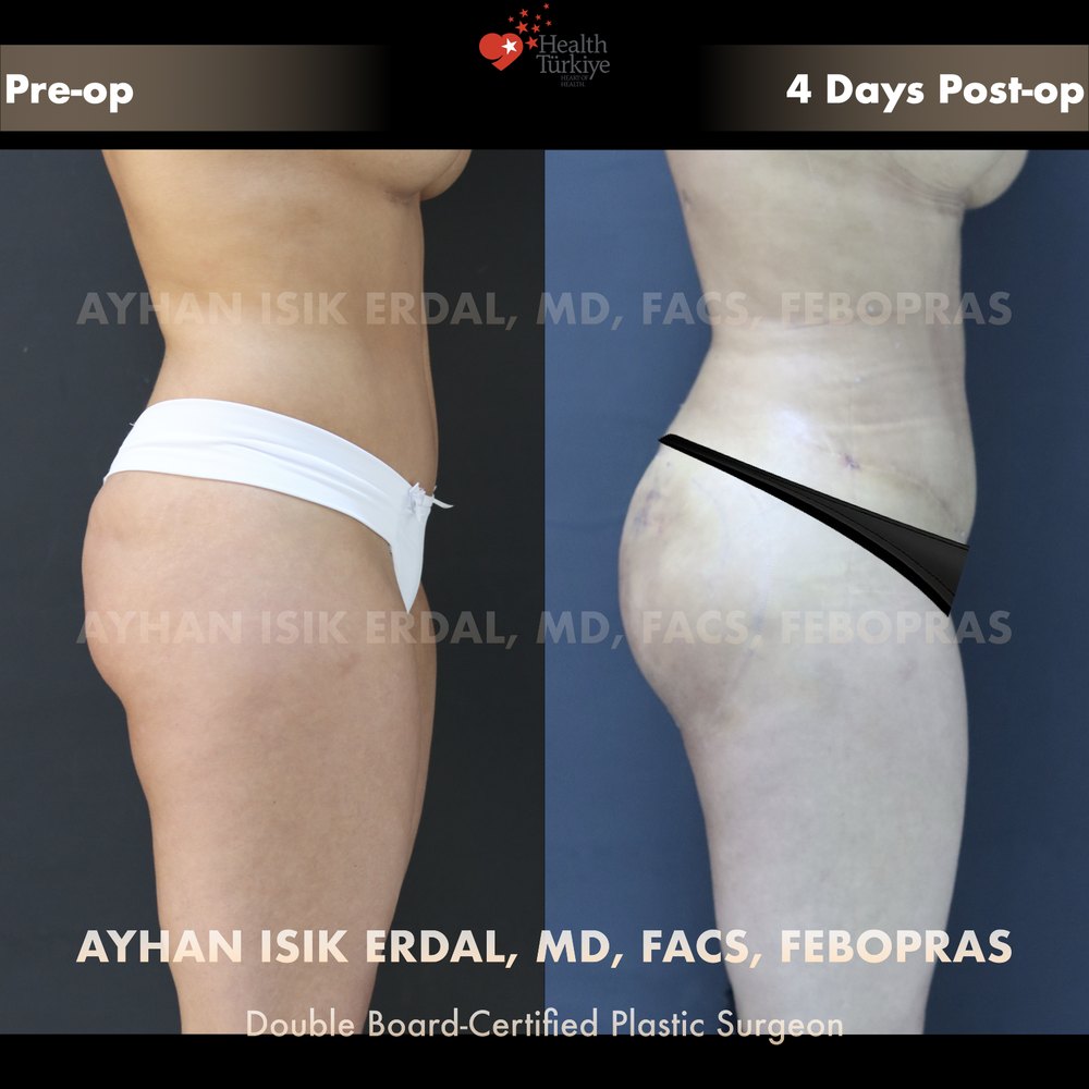 Waist contouring + hip & gluteal fat transfer — Side view, day 4 — projection and lateral fullness at the early stage, patient of Dr. Ayhan Işık Erdal, Istanbul